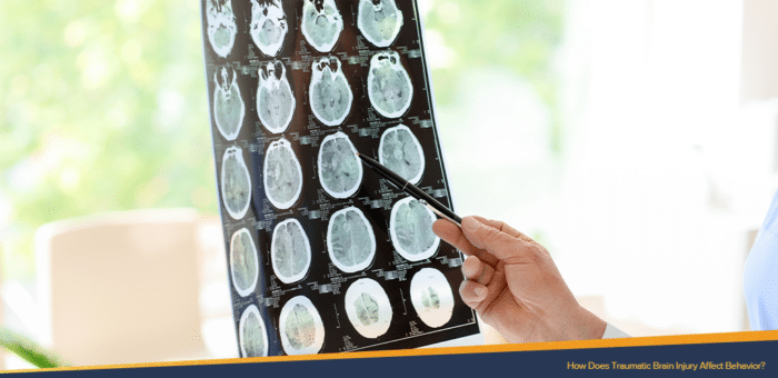 Unseen woman pointing a pen to a traumatic brain injury x-ray